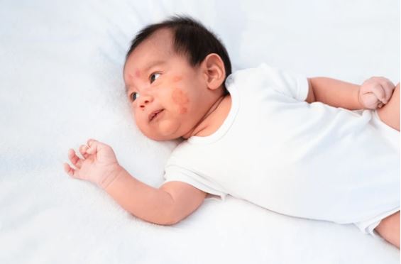 Paano gamutin ang mga common rashes ng baby – Sintomas at Remedy